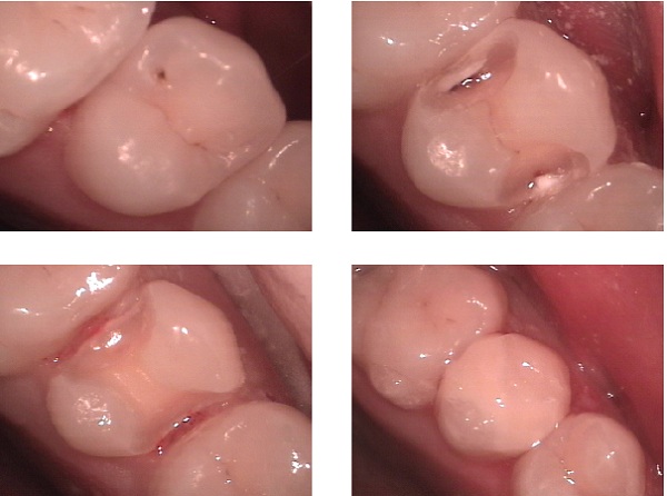 Dental Bonding in Lagos: The Fast, Affordable Way to Fix Chipped Teeth