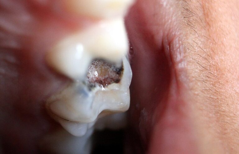 Toothache That Will Not Go Away? 7 Causes and When to See a Lagos Dentist