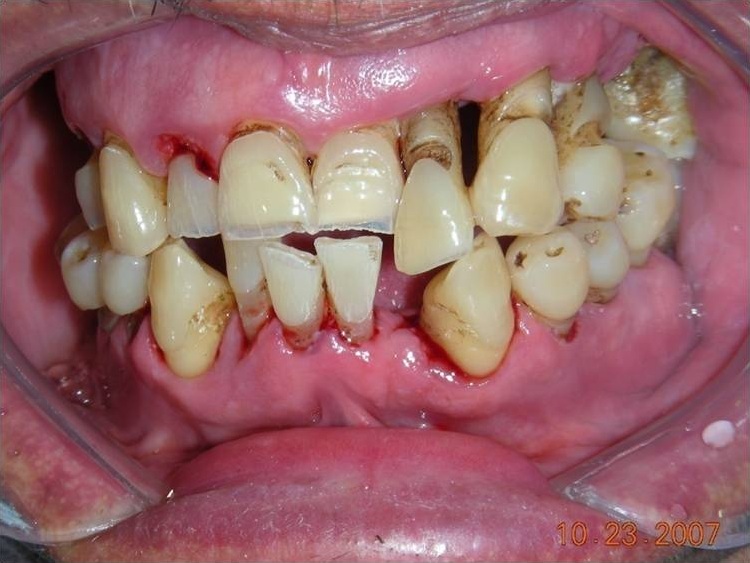 Bleeding Gums in Lagos: Causes, Symptoms, and When to See a Dentist