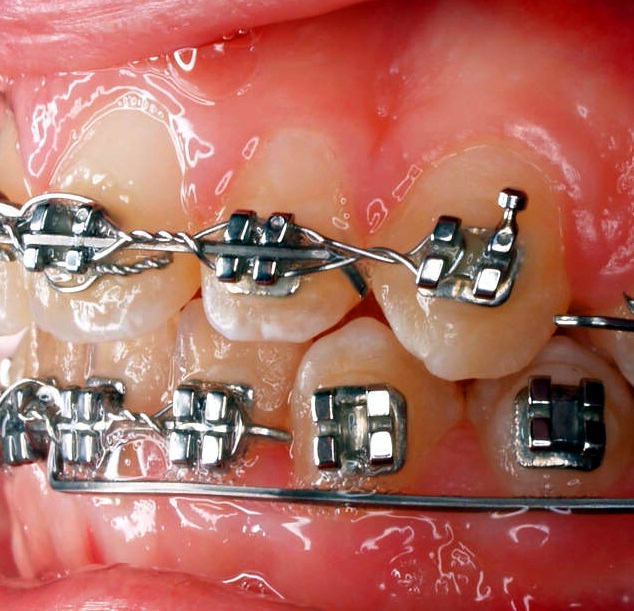 Dental Braces Cost in Lagos: Braces vs. Invisalign — Which Is Worth It in 2026?